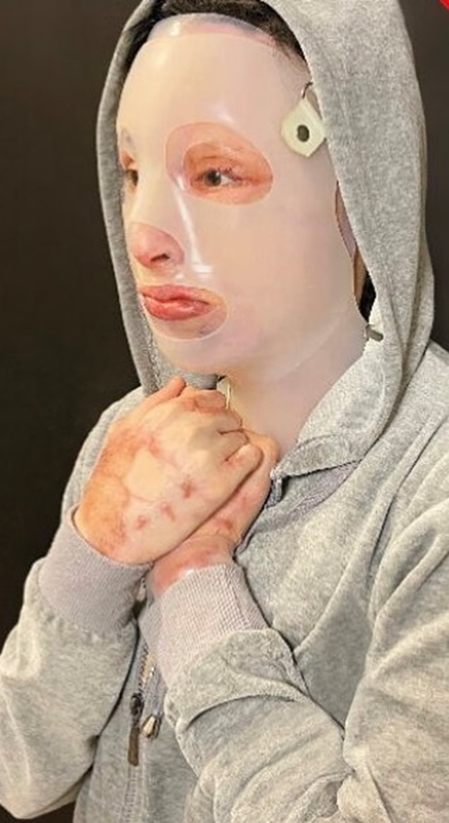 Οι συγκλονιστικές αποκαλύψεις για τη μάσκα της Ιωάννας: "Ο σκοπός της είναι να πιέσει τις ουλές για…"