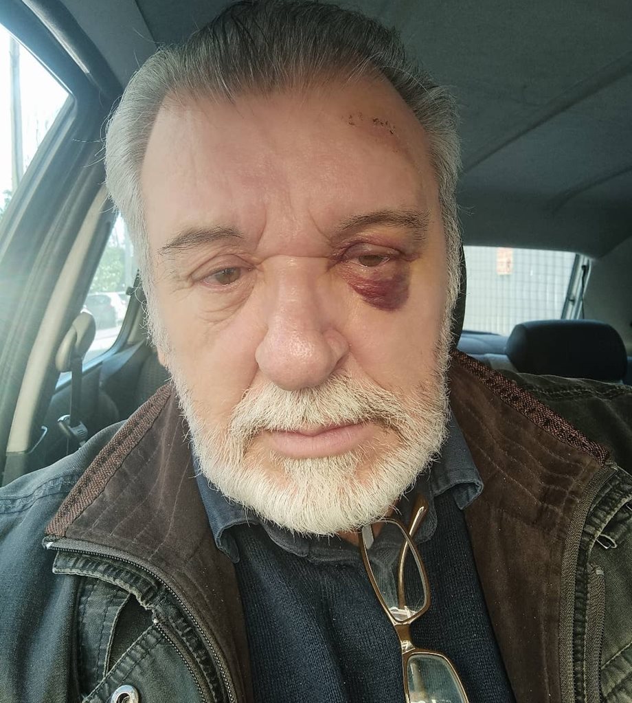 Τάσος Χαλκιάς: Η πρώτη δήλωση μετά το ατύχημα και τη φωτογραφία με το μελανιασμένο μάτι