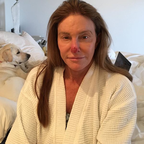Σοκάρει η φωτογραφία της Κέιτλιν Τζένερ: Το μελάνωμα που την οδήγησε στο χειρουργείο