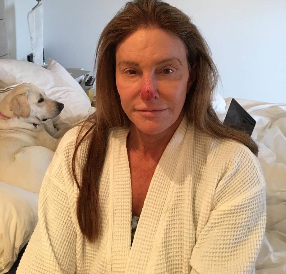 Σοκάρει η φωτογραφία της Κέιτλιν Τζένερ: Το μελάνωμα που την οδήγησε στο χειρουργείο