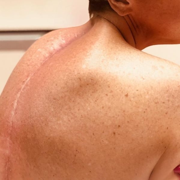 Σοκάρει πρώην παίκτρια ριάλιτι: Μας δείχνει την τεράστια ουλή στη σπονδυλική της στήλη ένα χρόνο μετά το χειρουργείο