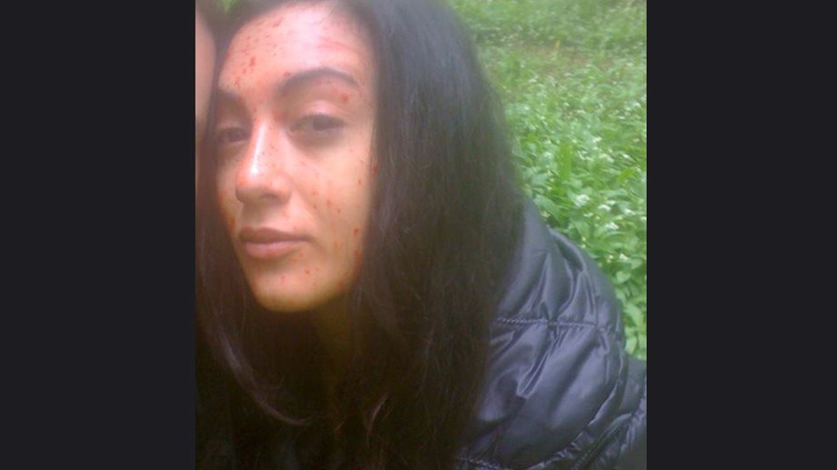 Ευγενία Σαμαρά: Γιατί γέμισε αίματα το πρόσωπό της;