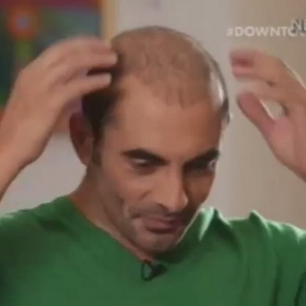 Αλέκος Συσσοβίτης: Μιλά για πρώτη φορά για την απώλεια των μαλλιών του - VIDEO