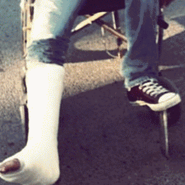 Ο Έλληνας ηθοποιός έσπασε το πόδι του και μετακινείται με καροτσάκι