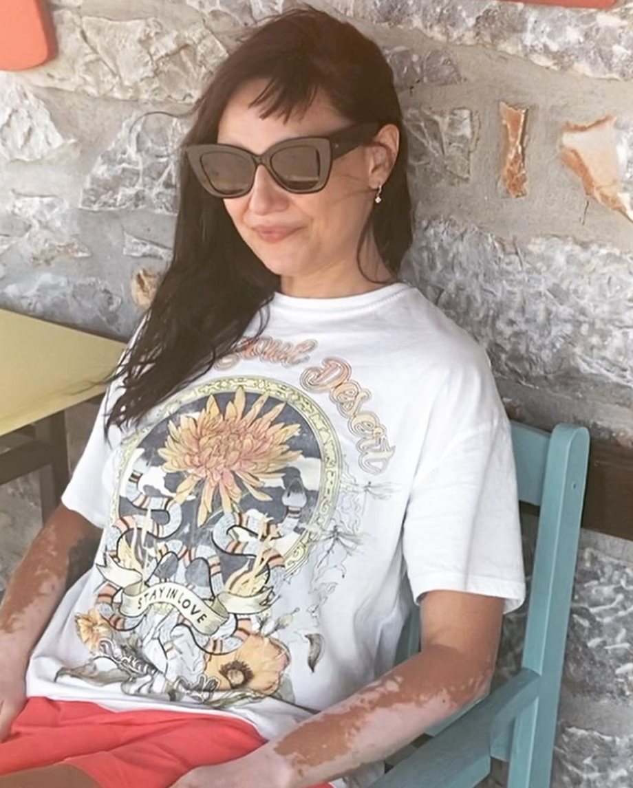 Αθηναΐς Νέγκα: Ποζάρει με σορτς και μας δείχνει τα σημάδια της λεύκης στο σώμα της