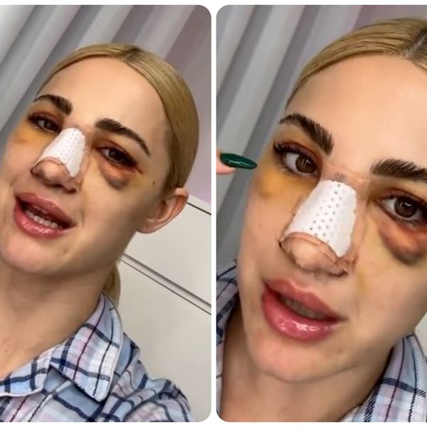 Ιωάννα Τούνη: Μας δείχνει το μελανιασμένο πρόσωπό της τρεις μέρες μετά την πλαστική στην μύτη